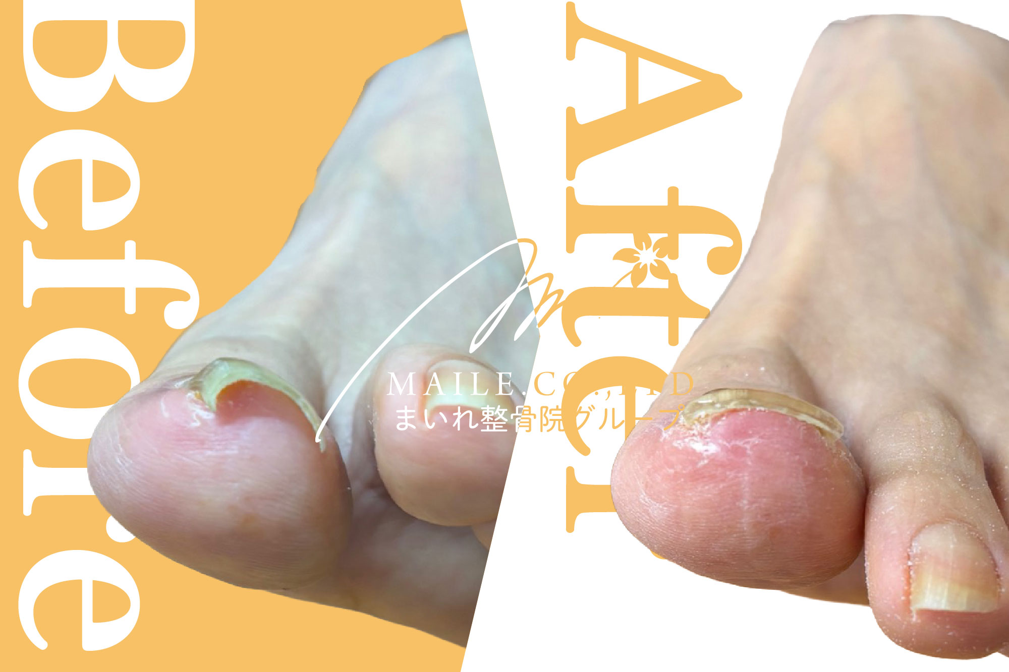 長浜市 巻き爪施術 ビフォーアフター