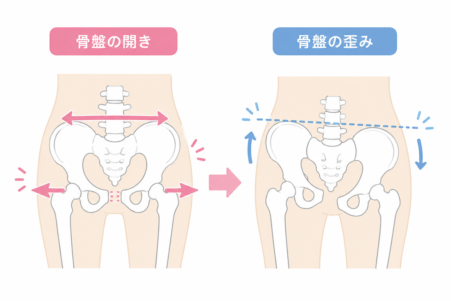 産後の骨盤の開きと歪みのイメージ|長浜市