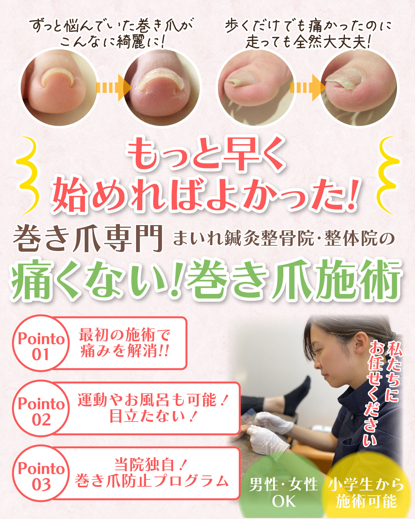 巻き爪